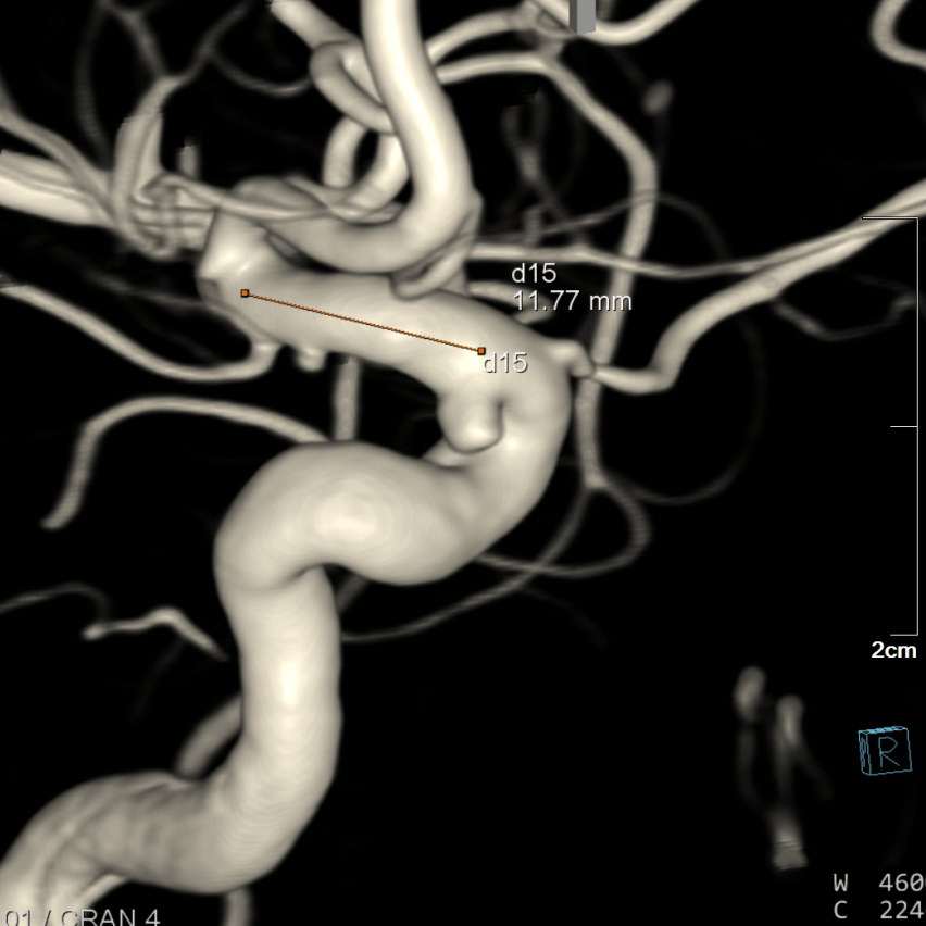 焕密网新生|海南首秀-高振忠教授团队:颈内动脉中小动脉瘤血流导向