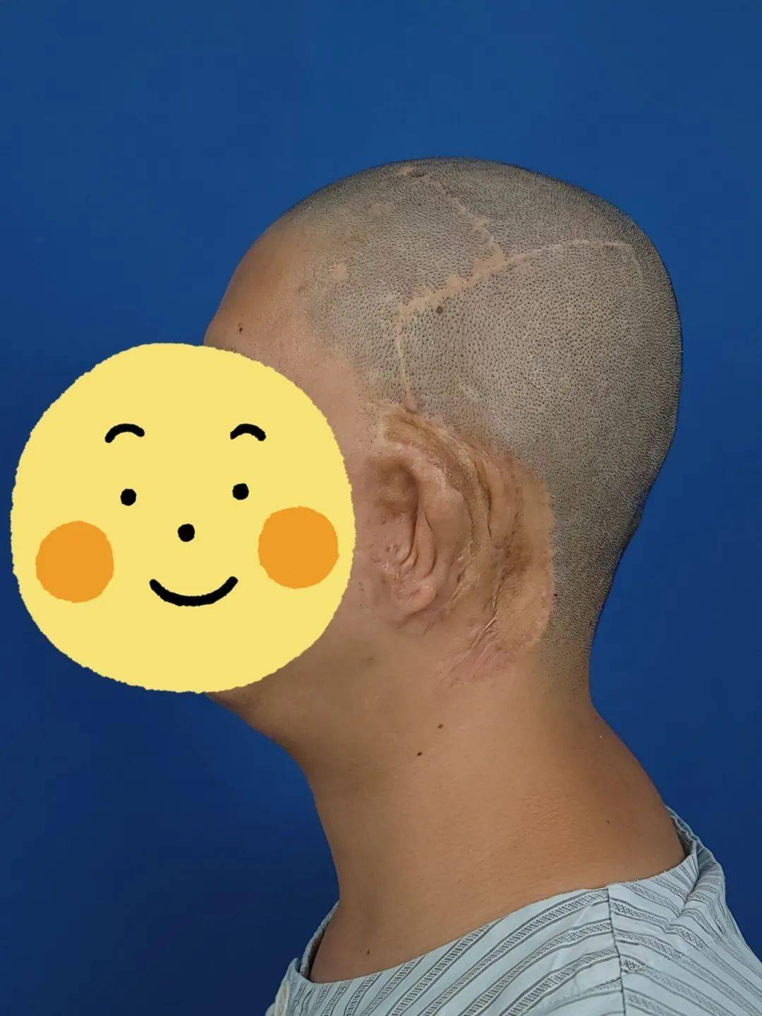 畸形耳朵手术整个过程多久_畸形耳朵手术效果_一只耳朵畸形手术