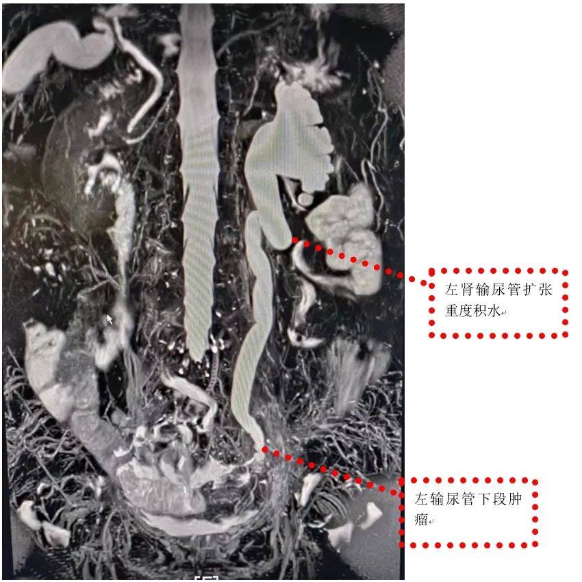 科普 | 容易漏诊的泌尿系肿瘤——输尿管癌