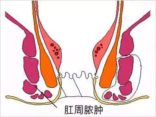 括约肌间肛瘘图片