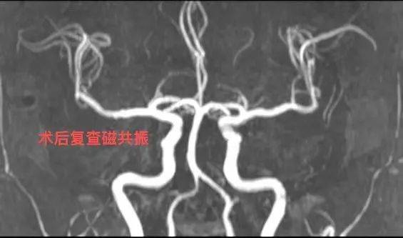 " 61岁大娘麻将桌突发脑梗 警医联动紧急实施静脉溶栓 开启生命速救