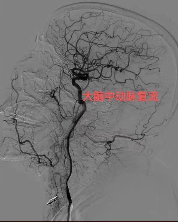 " 61岁大娘麻将桌突发脑梗 警医联动紧急实施静脉溶栓 开启生命速救