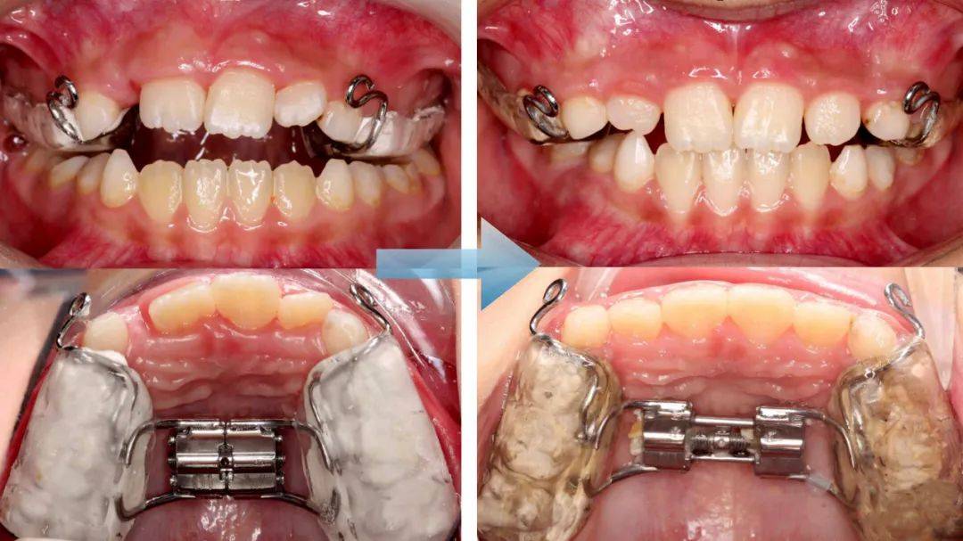 正畸临床病例——横向先行扩弓的方法与技巧