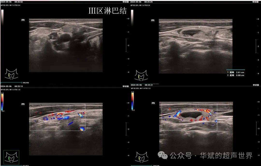 超声问答61甲状腺良性结节术后也会发生种植转移吗?