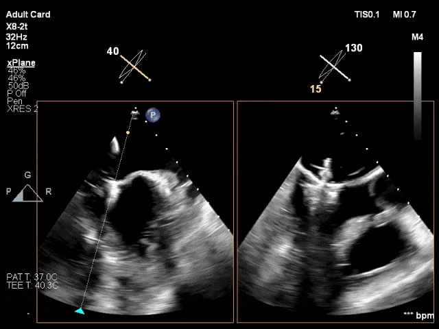 团队应用国产创新器械dragonfly顺利救治71岁高龄重度二尖瓣反流患者