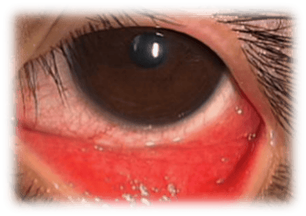 出现结膜炎,角膜炎,美瞳的凹度与角膜凸度不符,会造成角膜磨损,严重的