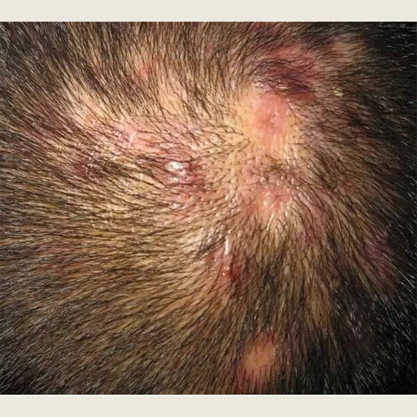 皮脂过多:头皮过度分泌皮脂会导致头皮油腻,促使头皮上的真菌生长