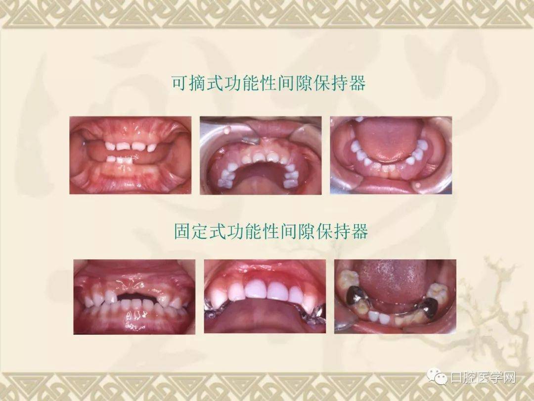 间隙保持器的种类,适应证及制作