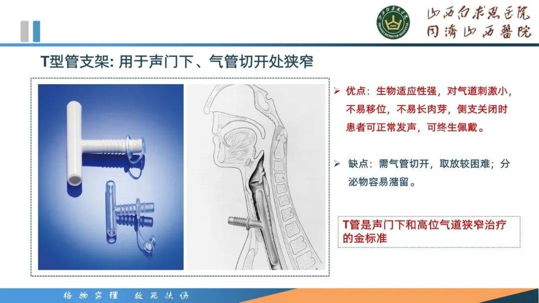 【ppt】1例气管切开后气道狭窄患者的护理案例分享