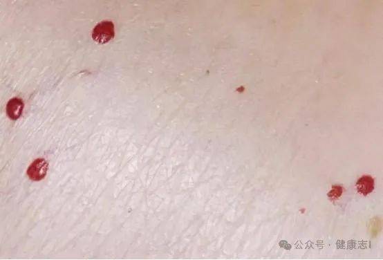 身上出现这种红点,警惕癌症风险!