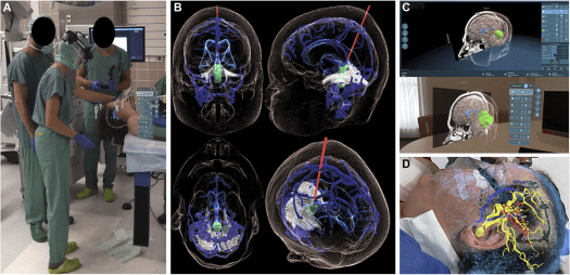 神经外科规划中的混合现实技术应用 | Neurosurgery blog