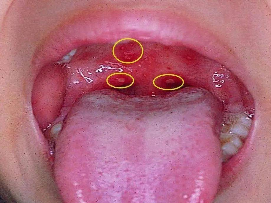 腭舌弓溃疡图片