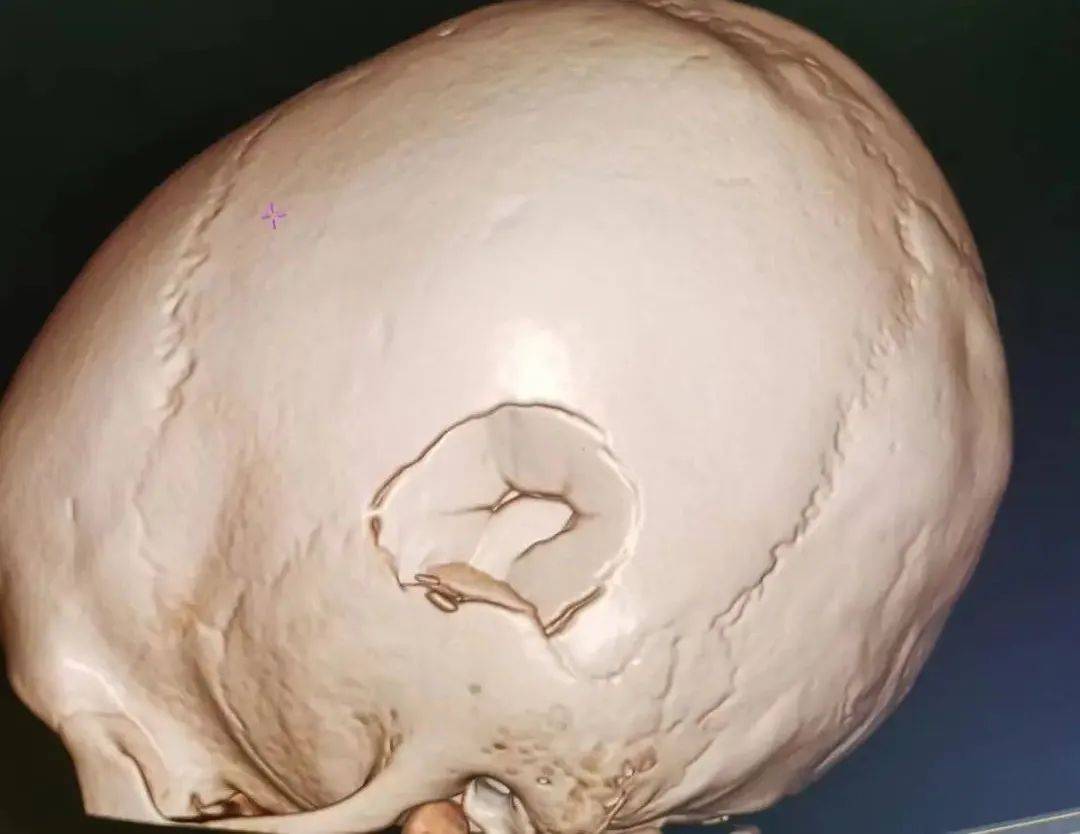 面对小雨的严重伤势,我院急诊科迅速开通颅脑创伤救治绿色通道,同时