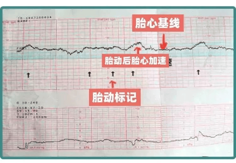 胎心监护 宝宝的守护神