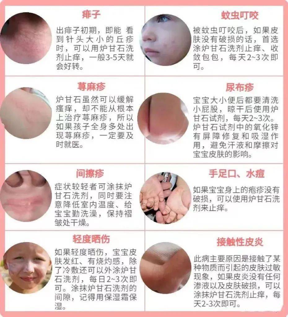 炉甘石不是万能药,儿科药师警告:这6种情况不能用!