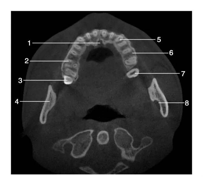 上下颌骨ct平扫解剖图片