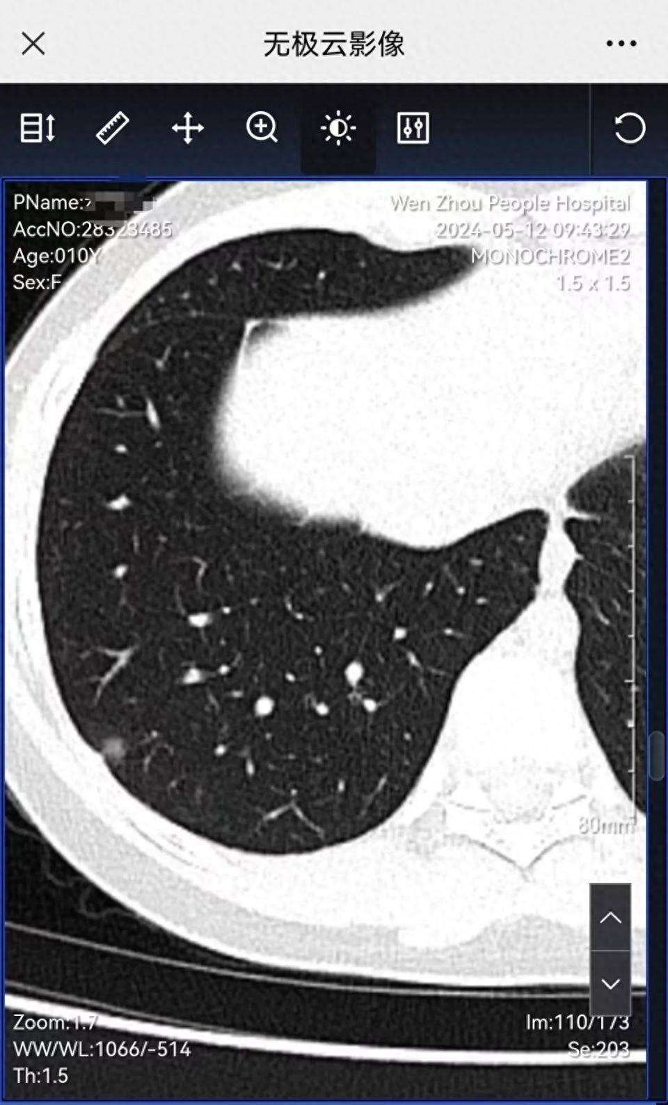 温州一女孩才10岁被确诊肺癌(图1)