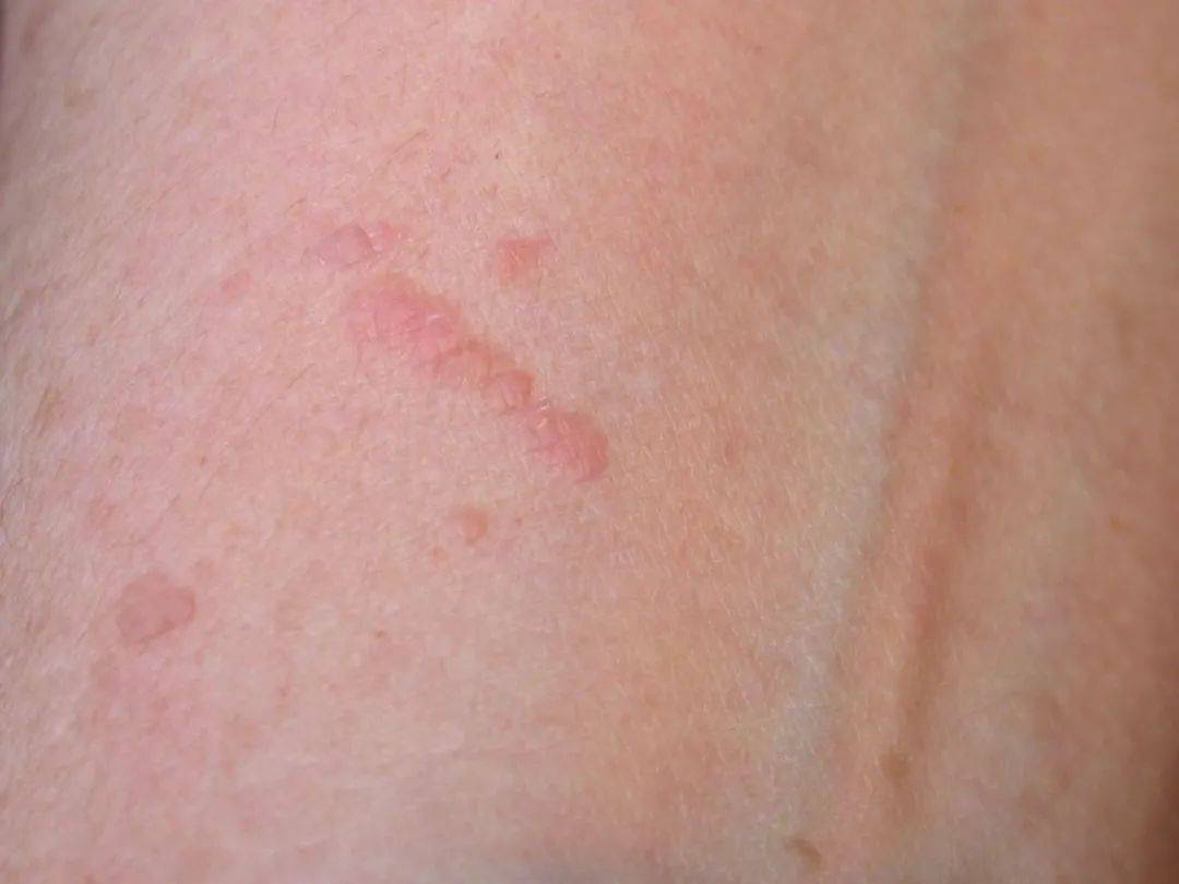 扁平疣好发于面部,颈部,手背,手臂,表现为 1~3mm 大小的圆形或者椭圆