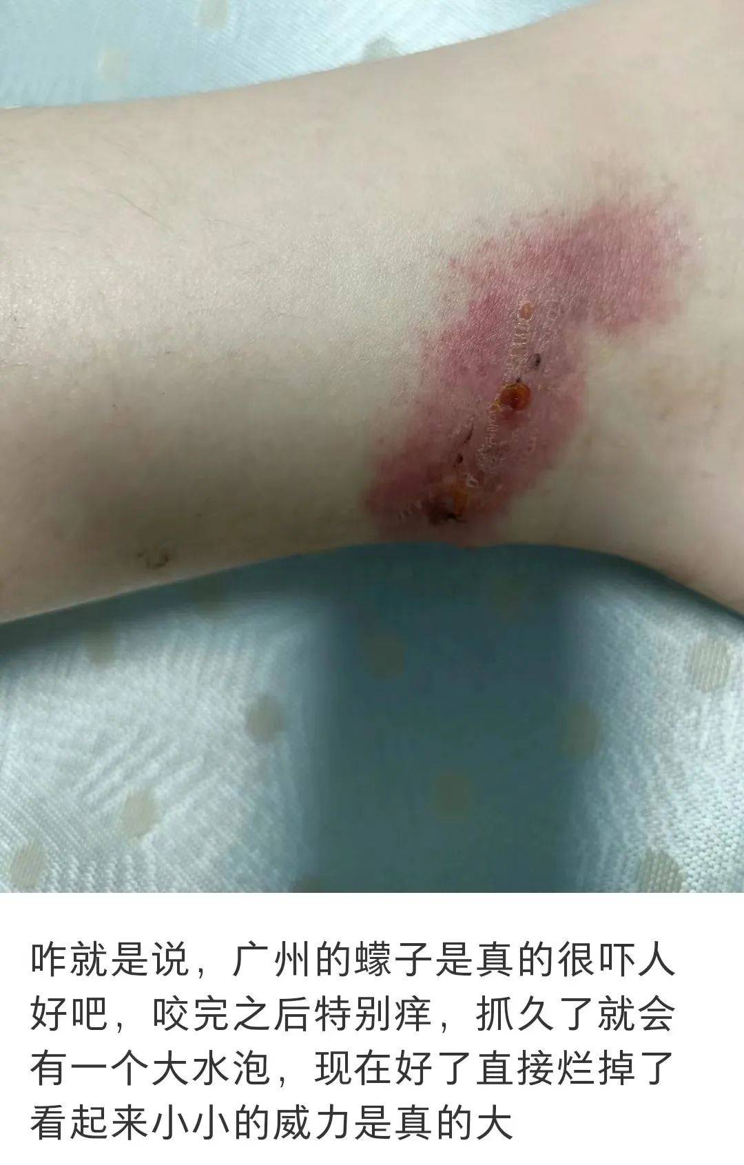 回到家才发现自己成了一群虫子的口粮毫无防备关键是它咬人没感觉这蠓