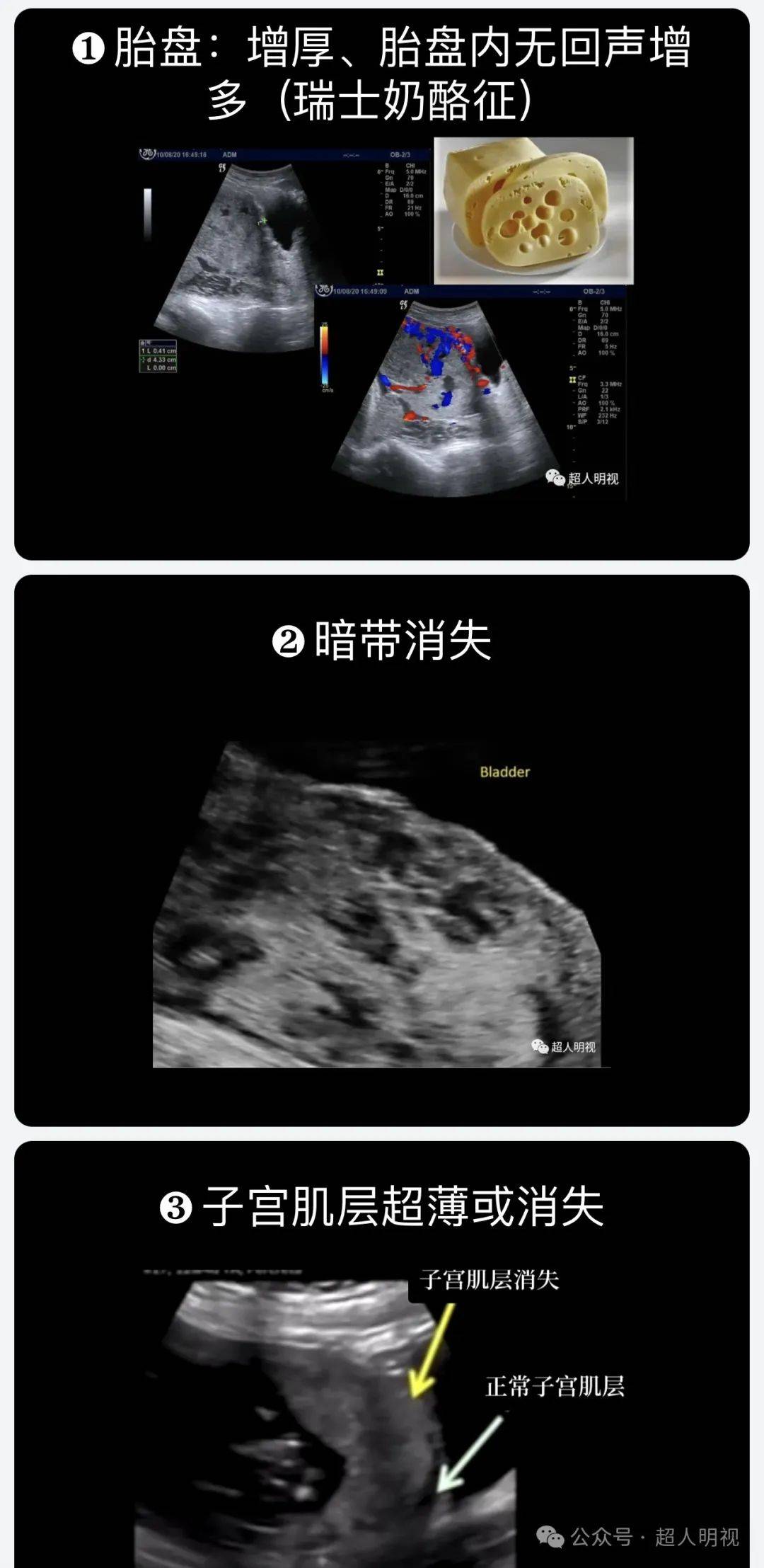 副胎盘超声声像图图片