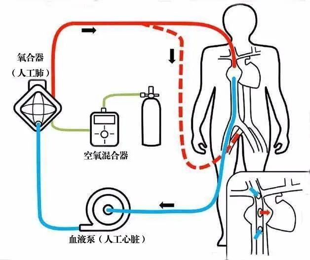 心脏手术的守护者 麻醉科手术室体外循环团队