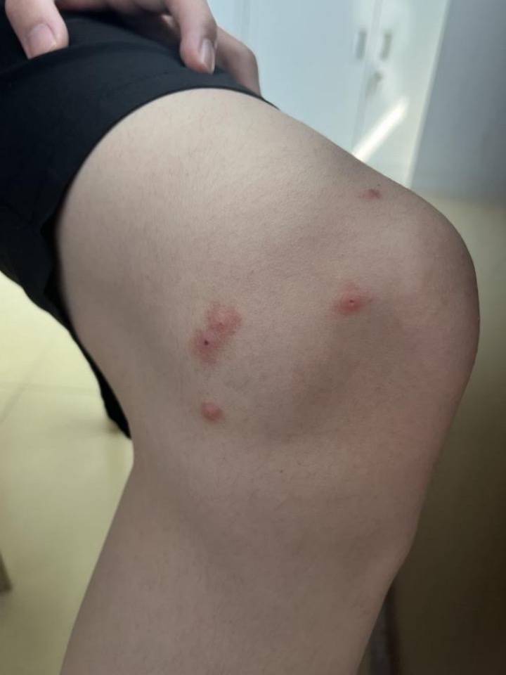 女孩腿上长带水疱红疹涂花露水无效,医生:是虫咬皮炎,可涂抹炉甘石