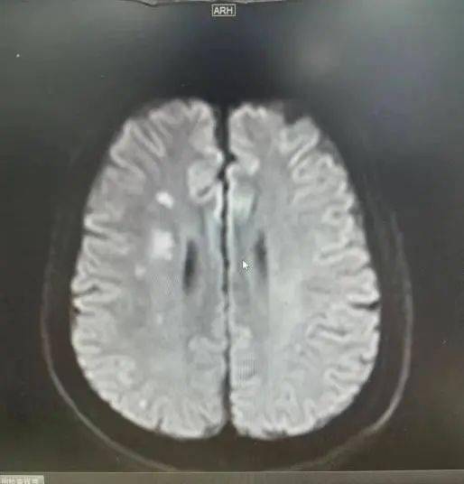 头颅dwi头颅ct术前检查2查体:神经系统查体未见明显阳性体征.