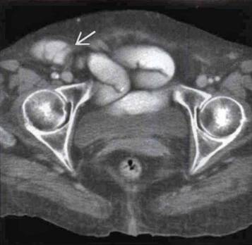 20个腹壁病变的ct表现