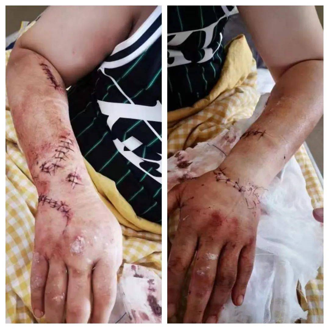 山西一辅警头部被砍五刀,双臂多处被砍伤!