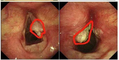 喉咙有瘤子图片图片