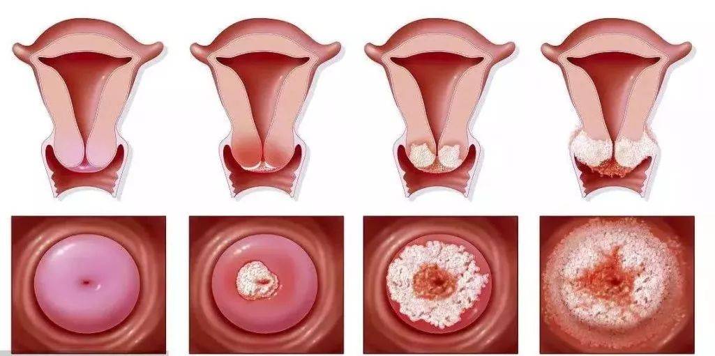 宫颈癌图片晚期图片