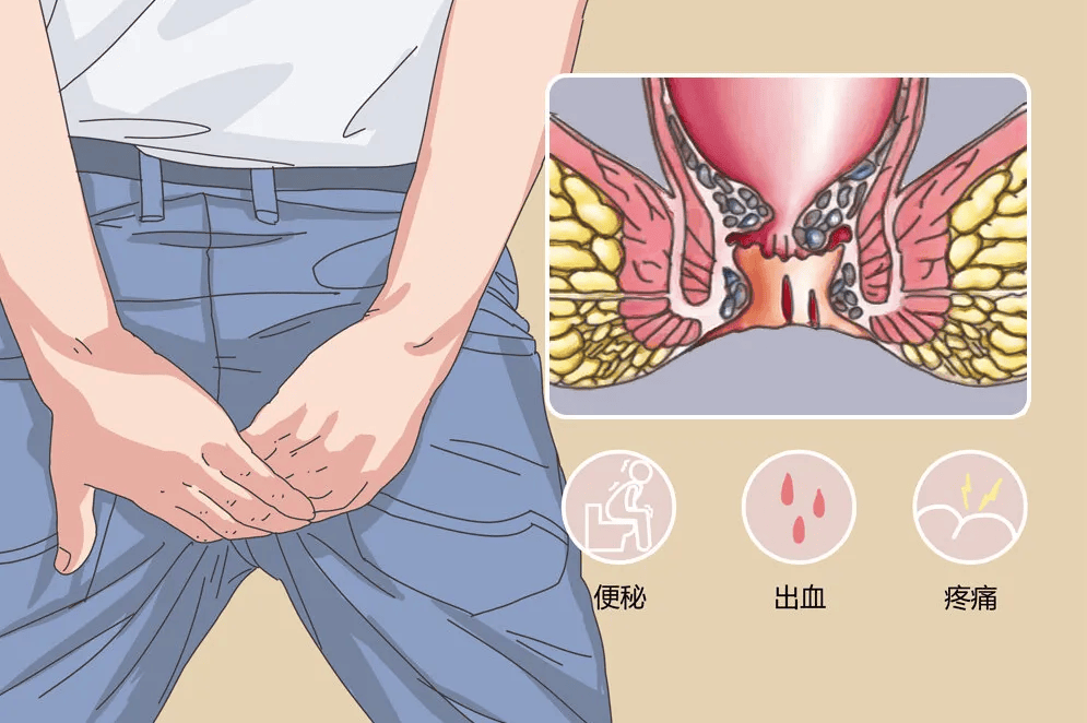 痔疮是肛门周围静脉曲张形成的肿块