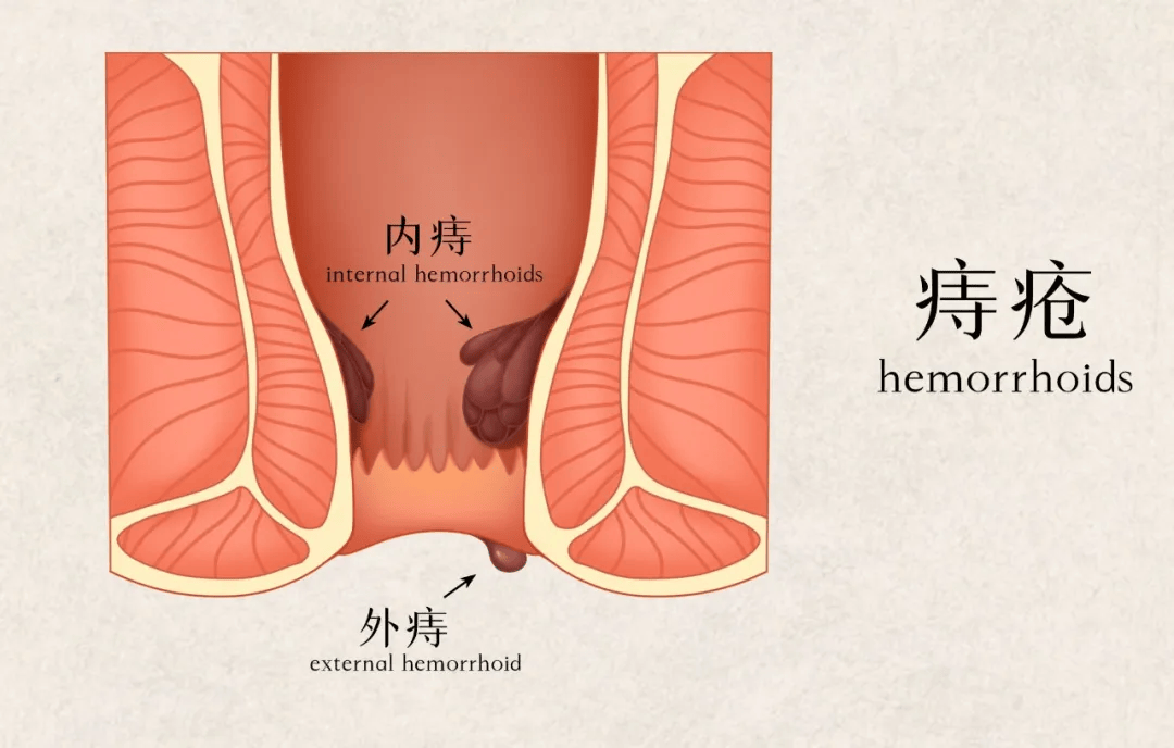 轻微痔疮轻度图片