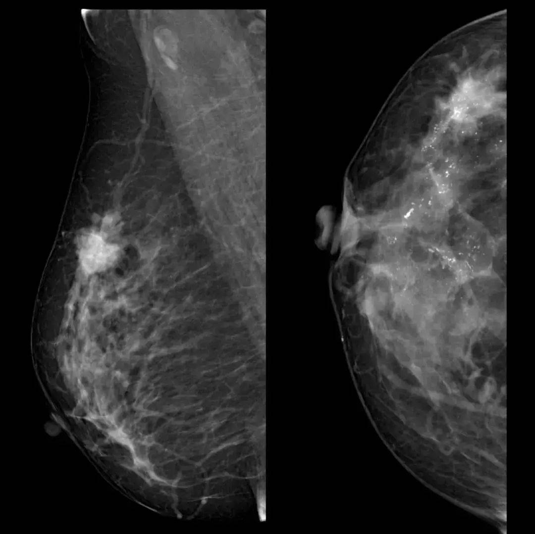 乳腺钙化灶是指做超声或者钼靶等乳腺影响学检查时的一种病灶,通常为