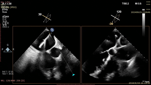 第二枚二尖瓣夹置入及关闭术后dragonfly64经导管二尖瓣夹系统1.