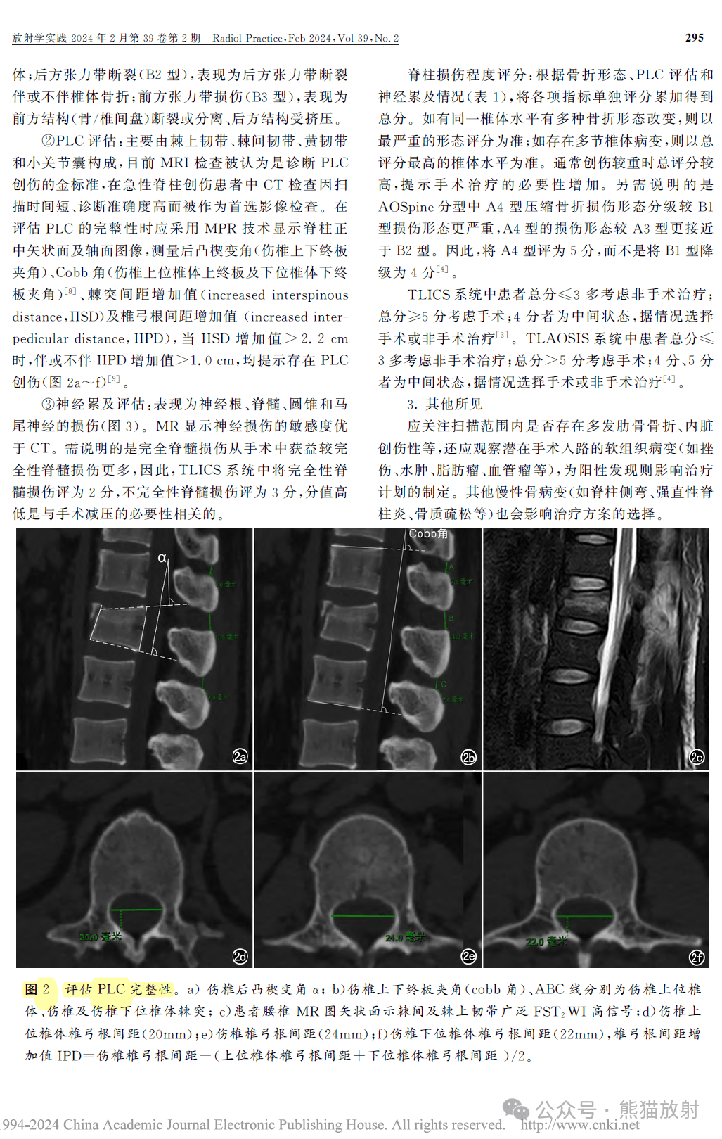 综述丨胸腰椎创伤的ct诊断:胸腰椎创伤分类和严重评分(tlics)与结构化