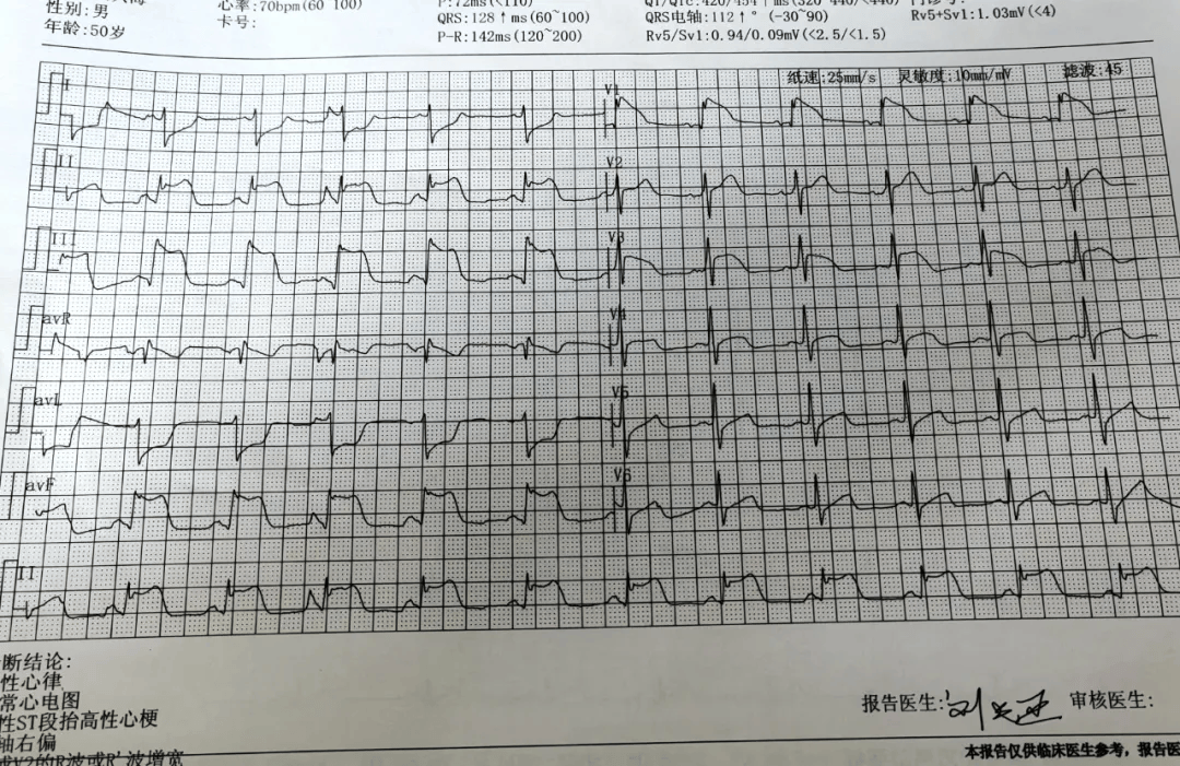 心电图提示急性st段