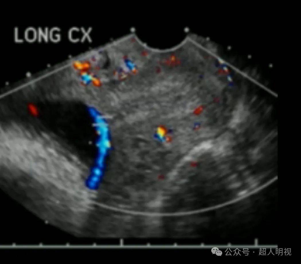 胎儿血管前置的临床处理