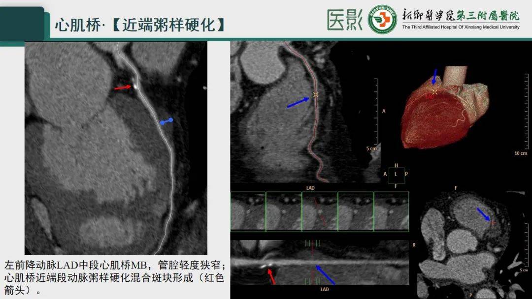 冠脉cta—心肌桥诊断要点