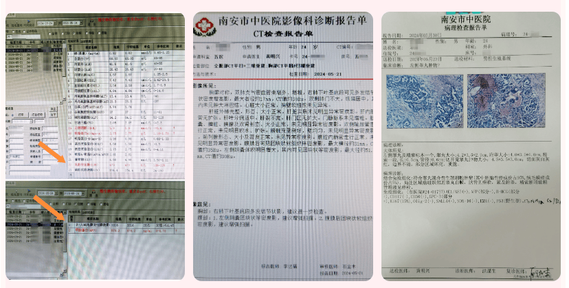 睾丸癌的检查结果图片图片