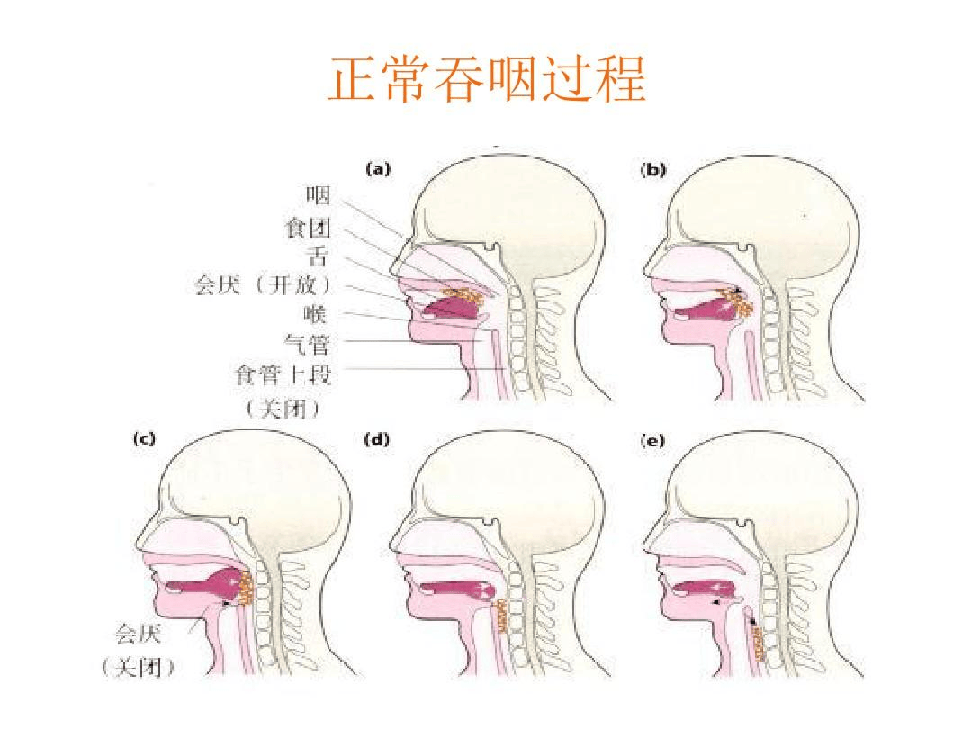 洼田饮水试验ppt图片