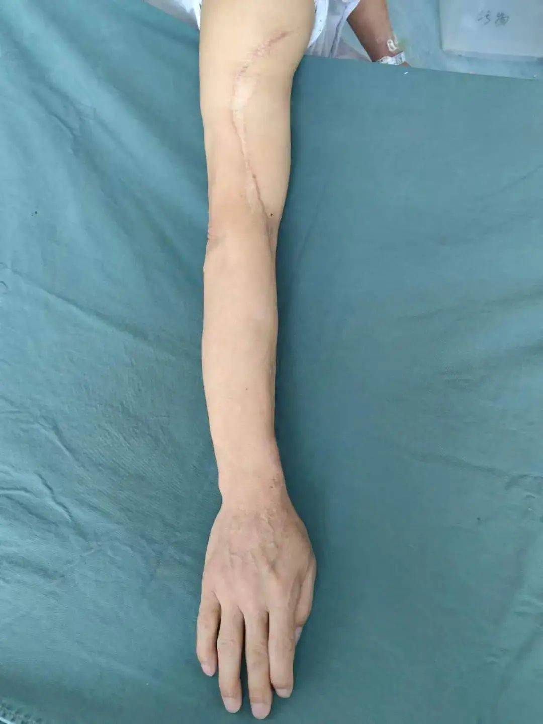 围观泸州男子整个右手臂被卷入传送带