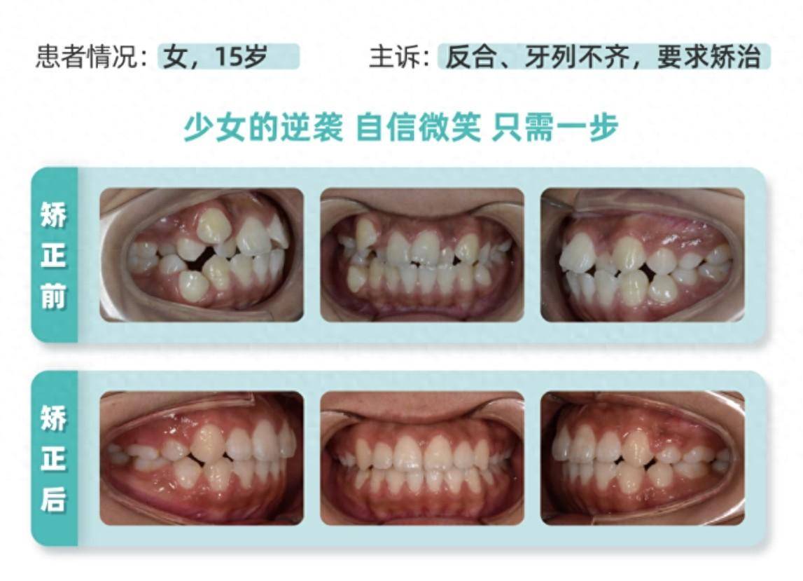 牙齿怎样才算整齐图片图片