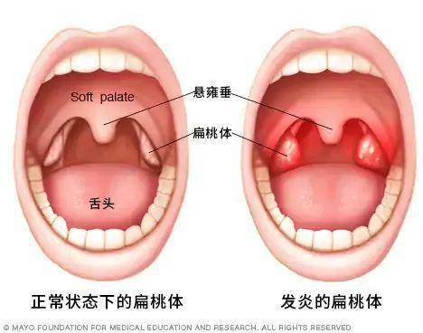 孩子扁桃体老发炎