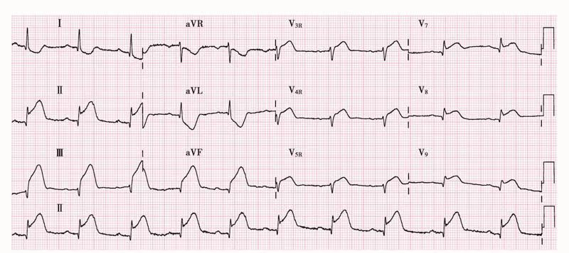 9 张实例,吃透急性心梗心电图!建议收藏