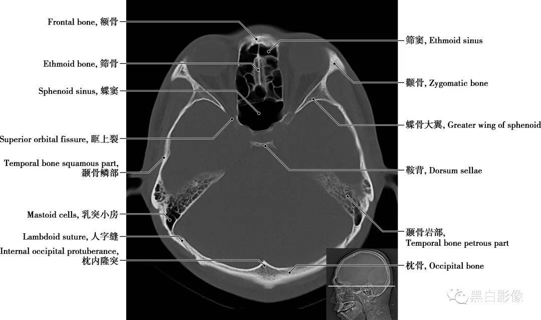 小脑蚓部正常影像解剖图片