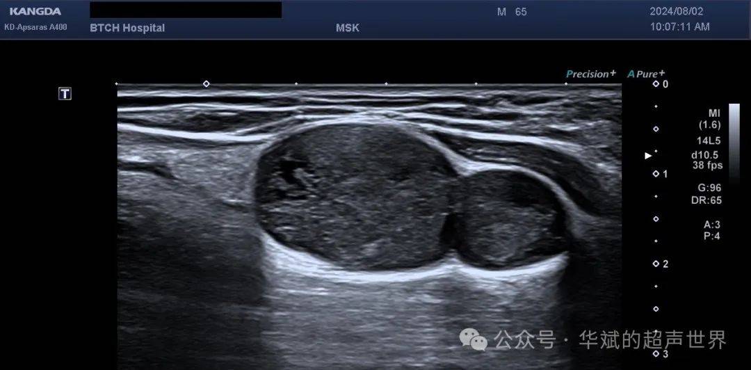 典型病例61(桡神经)丛型神经纤维瘤