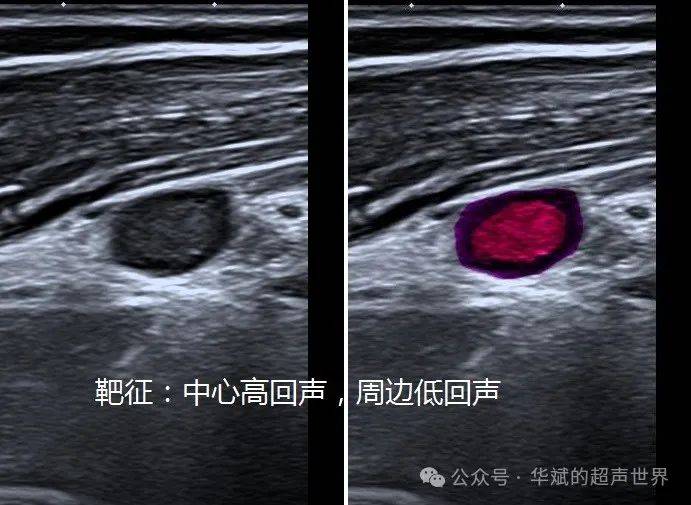 典型病例61(桡神经)丛型神经纤维瘤