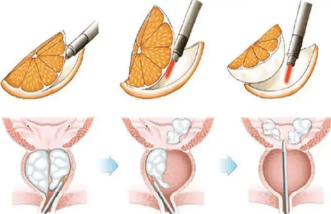 潍坊地区首台,铥激光剜除前列腺增生解决"男"言之隐_技术_手术_尿道