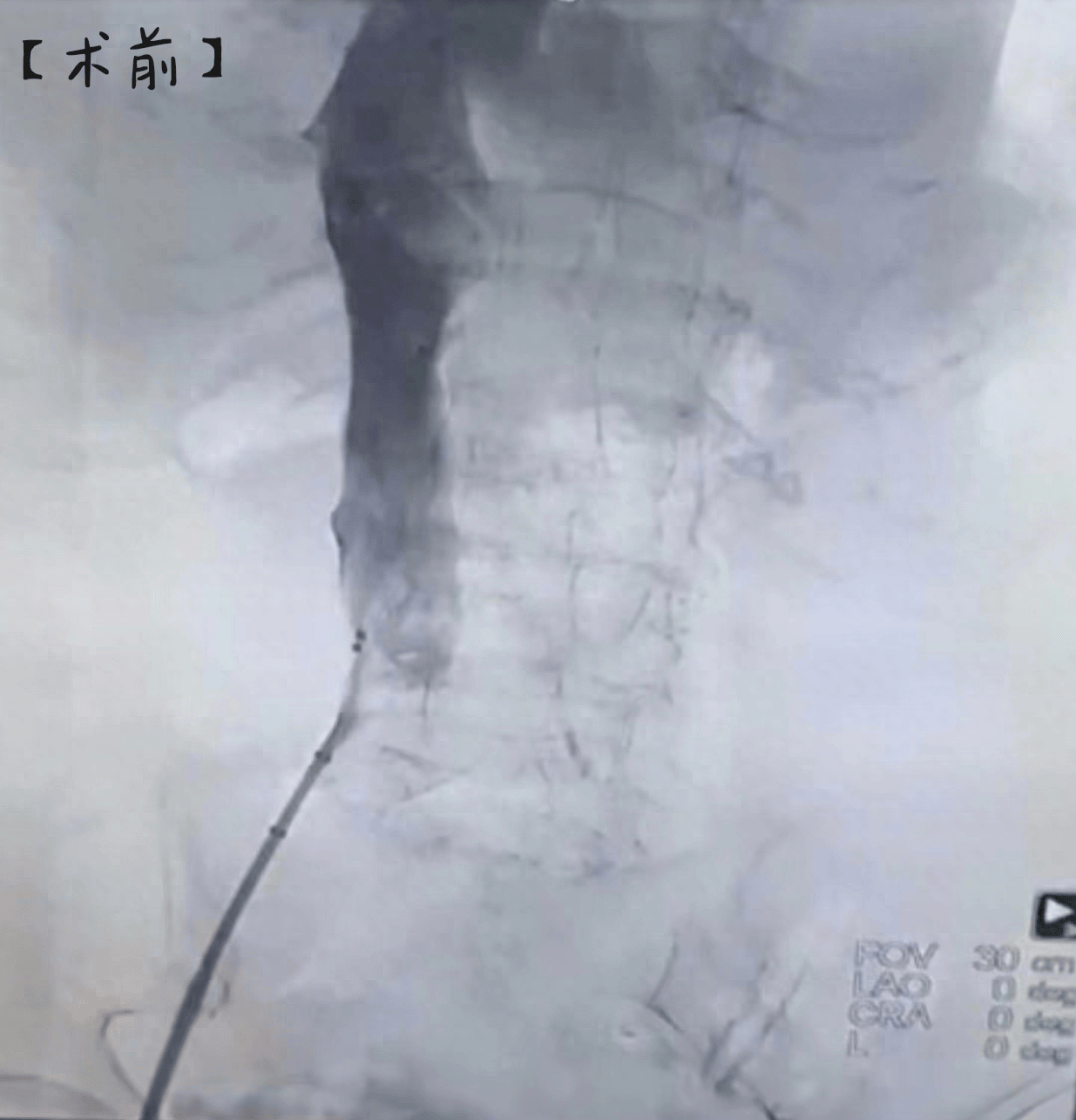 下腔静脉滤器置入术图片